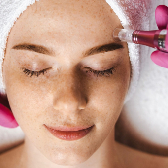 میکرونیدلینگ در کوکیتلام ونکوور