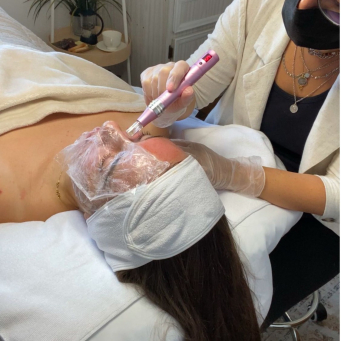 میکرونیدلینگ - کوکیتلام