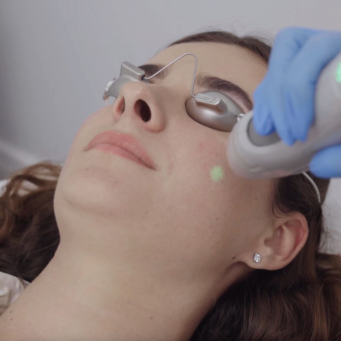 لیزر تمام صورت - نیومارکت