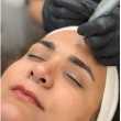 مزونیدلینگ صورت در تورنتو