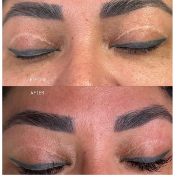 درمان اسکار و ترک در تورنتو