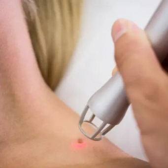 برداشتن زوائد پوستی در ونکوور