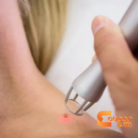 Laser & Skin