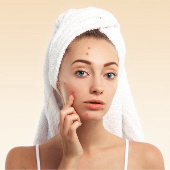 درمان آکنه صورت در تورنتو