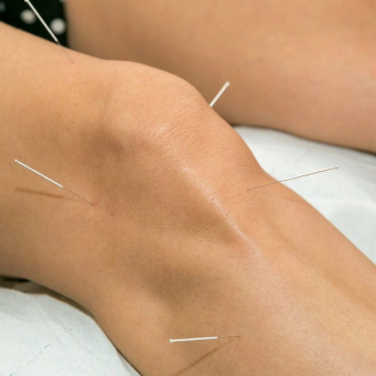 Acupuncture