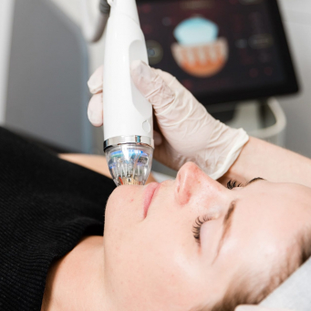 لیزر صورت در کوکیتلام ونکوور